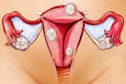 Kaj je maternični fibroid - vzroki, znaki, zdravljenje